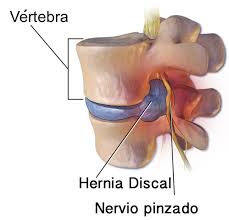 Qué es una hernia discal?