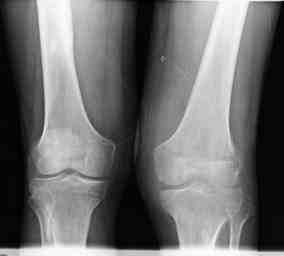 radiografia-rodilla-artritis