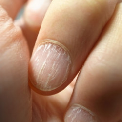 Por qué aparecen las estrías en las uñas? - El blog de Ch Salud